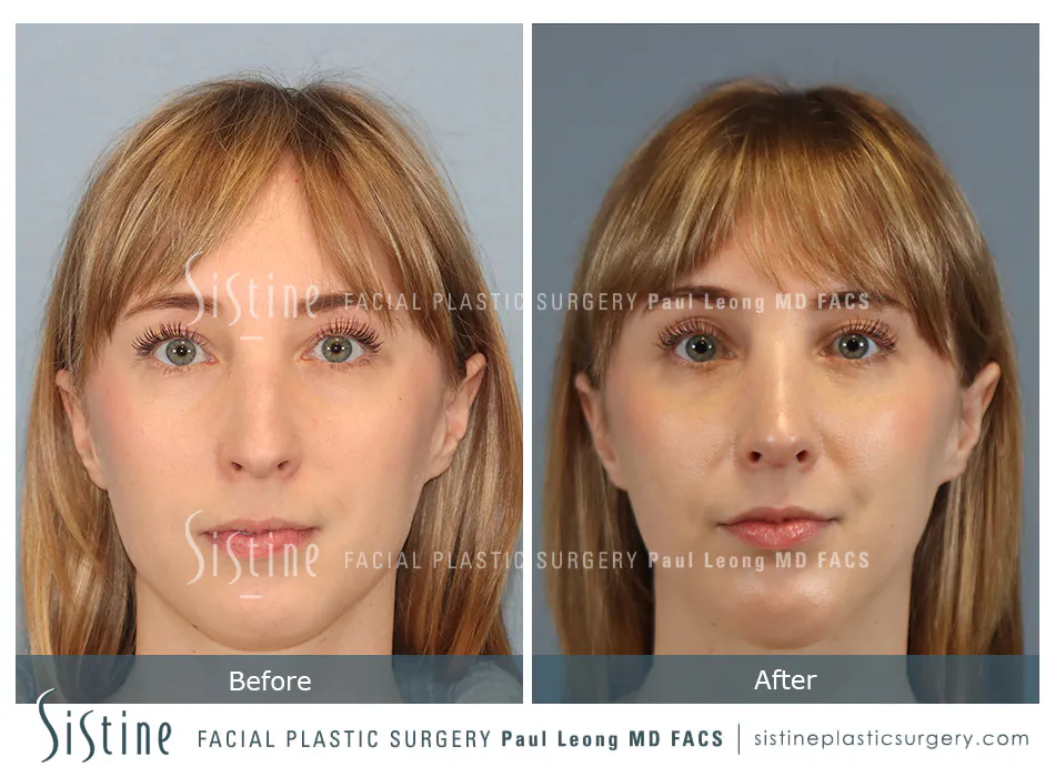 Chin Implant Before and After | Leong Facial Plastic Surgery