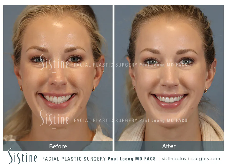 Chin Implant Before and After | Leong Facial Plastic Surgery
