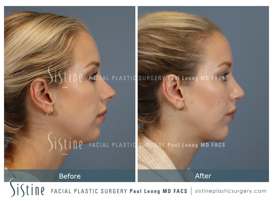 Chin Implant Before and After | Leong Facial Plastic Surgery