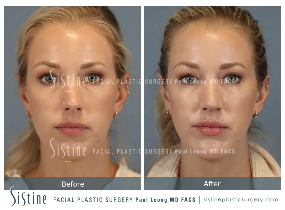 Chin Implant Before and After | Leong Facial Plastic Surgery