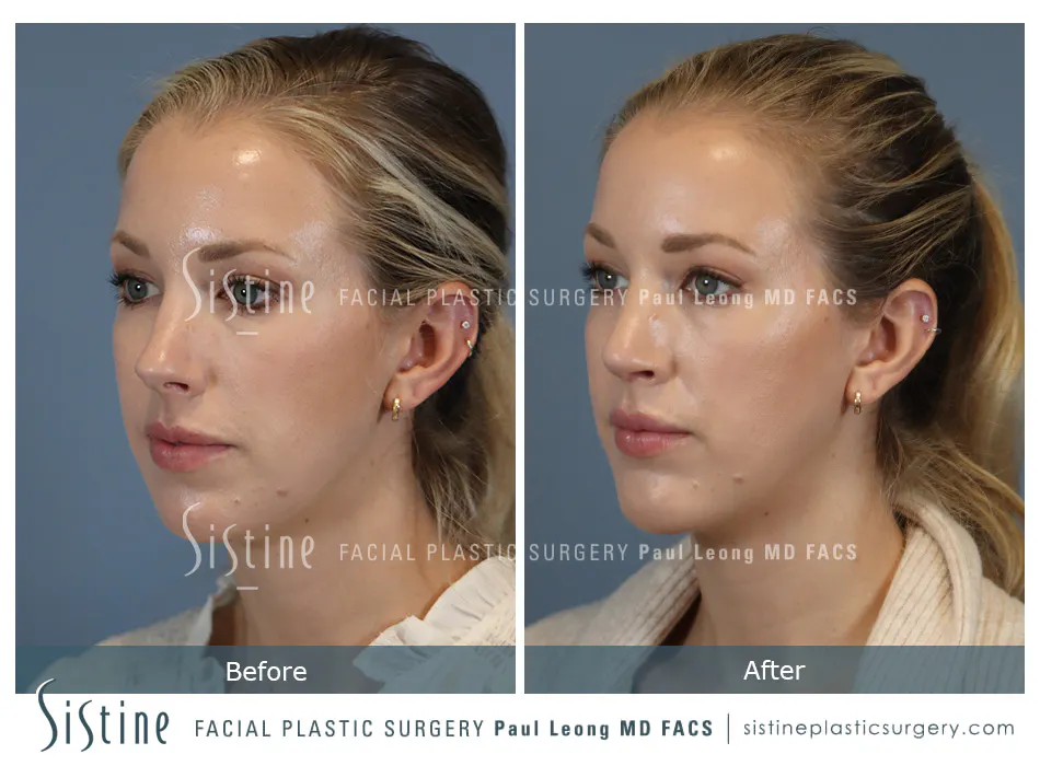 Chin Implant Before and After | Leong Facial Plastic Surgery