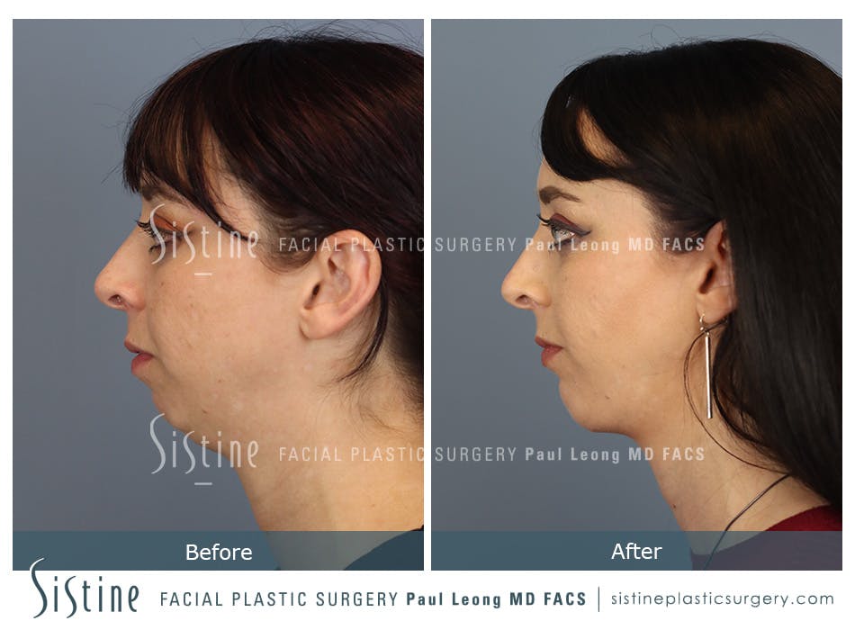 Chin Implant Before and After | Leong Facial Plastic Surgery