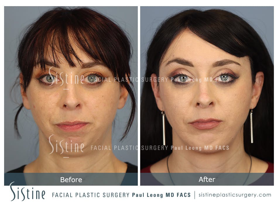 Chin Implant Before and After | Leong Facial Plastic Surgery