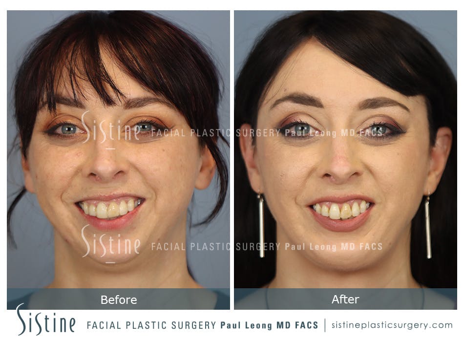 Chin Implant Before and After | Leong Facial Plastic Surgery