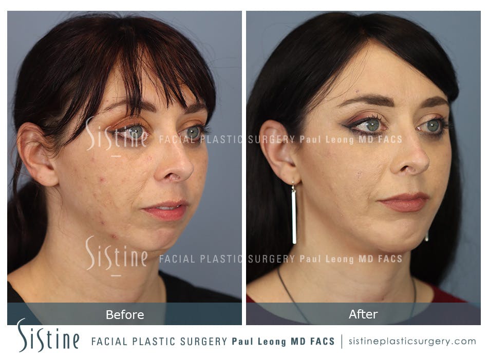 Chin Implant Before and After | Leong Facial Plastic Surgery