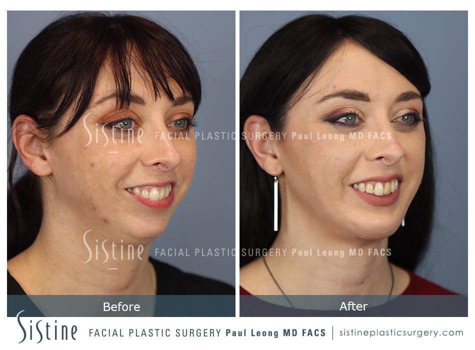 Chin Implant Before and After | Leong Facial Plastic Surgery