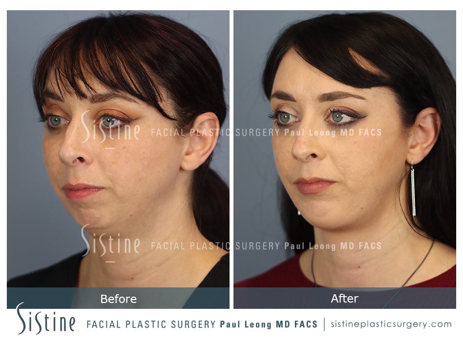 Chin Implant Before and After | Leong Facial Plastic Surgery