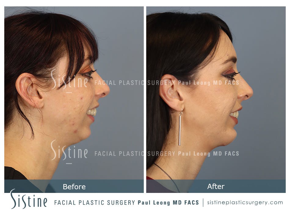 Chin Implant Before and After | Leong Facial Plastic Surgery