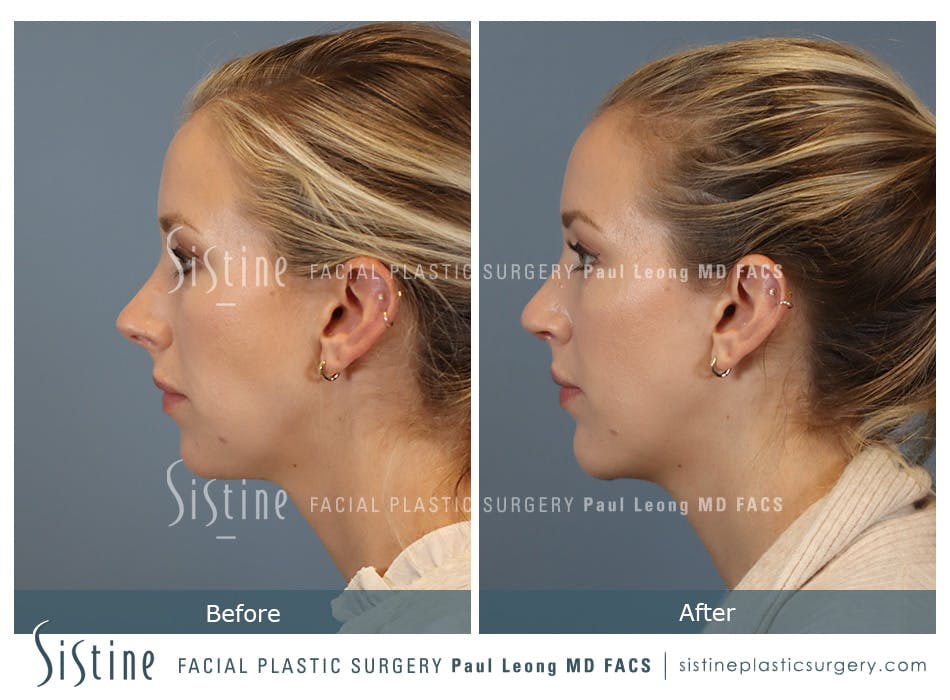 Chin Implant Before and After | Leong Facial Plastic Surgery