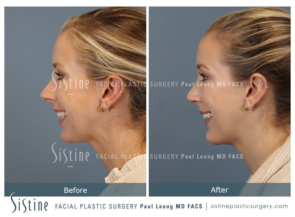 Chin Implant Before and After | Leong Facial Plastic Surgery