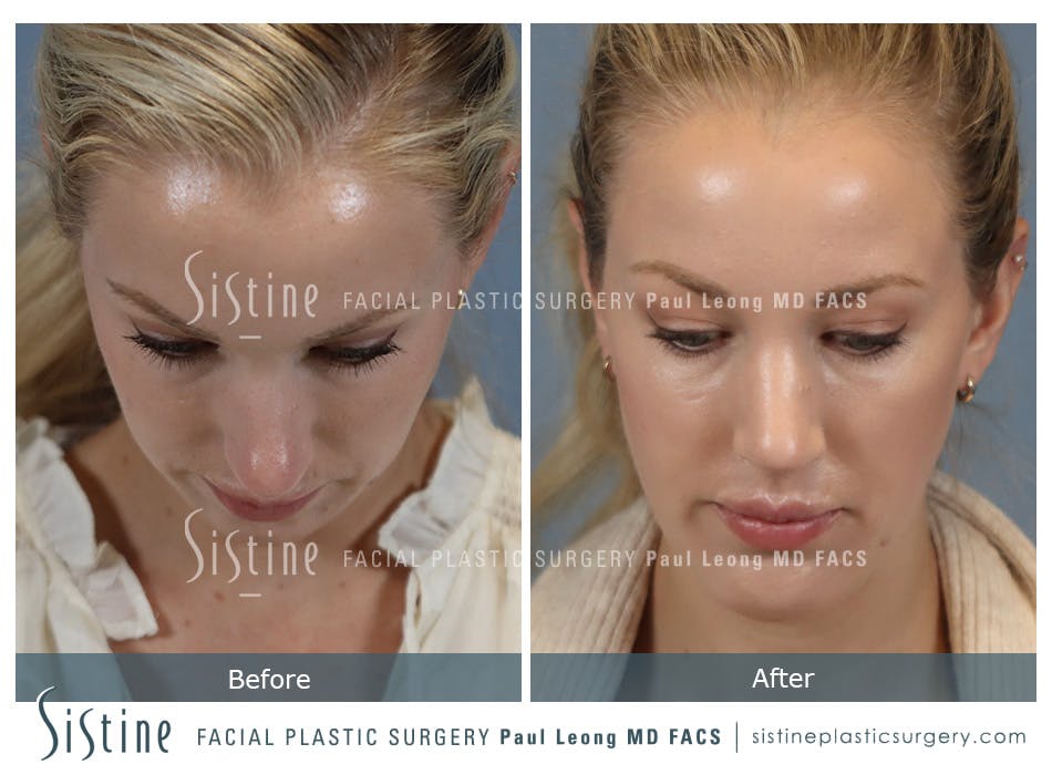 Chin Implant Before and After | Leong Facial Plastic Surgery