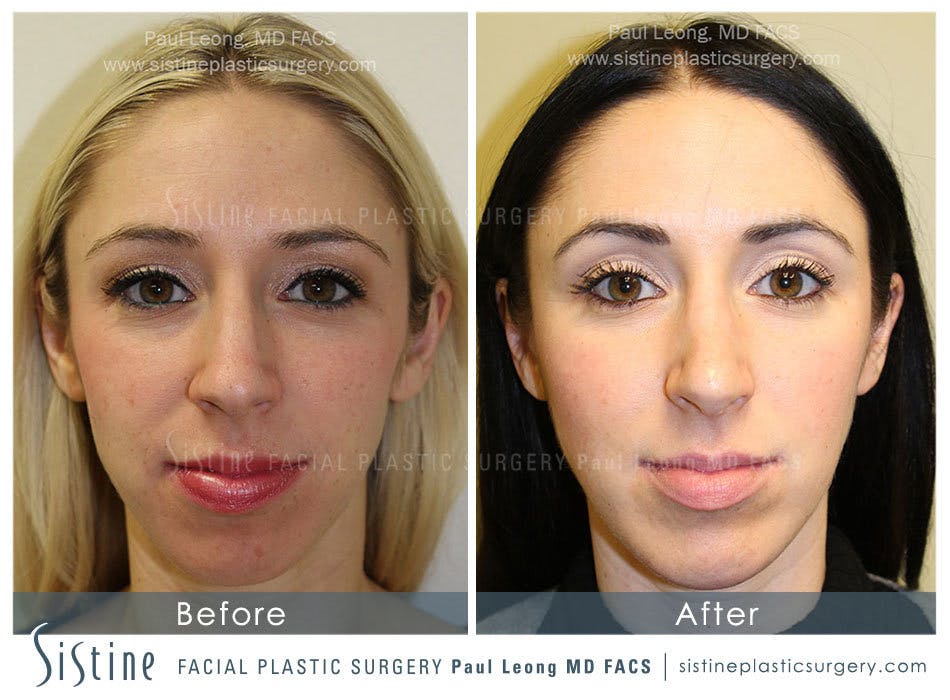 Chin Implant Before and After | Leong Facial Plastic Surgery