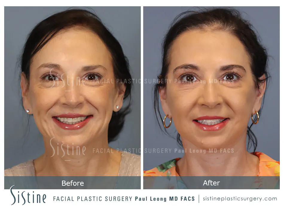 Deep Neck Lift Before and After | Leong Facial Plastic Surgery