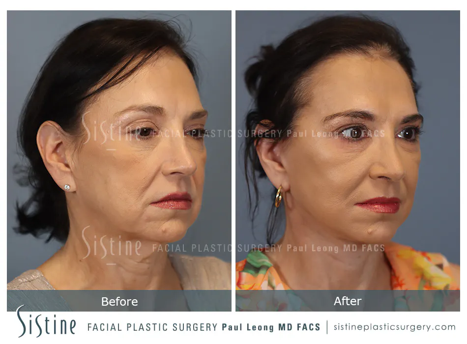 Deep Neck Lift Before and After | Leong Facial Plastic Surgery