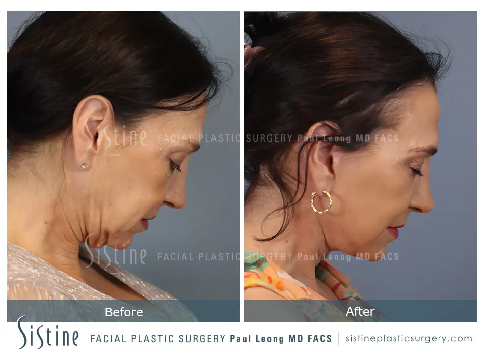 Deep Neck Lift Before and After | Leong Facial Plastic Surgery