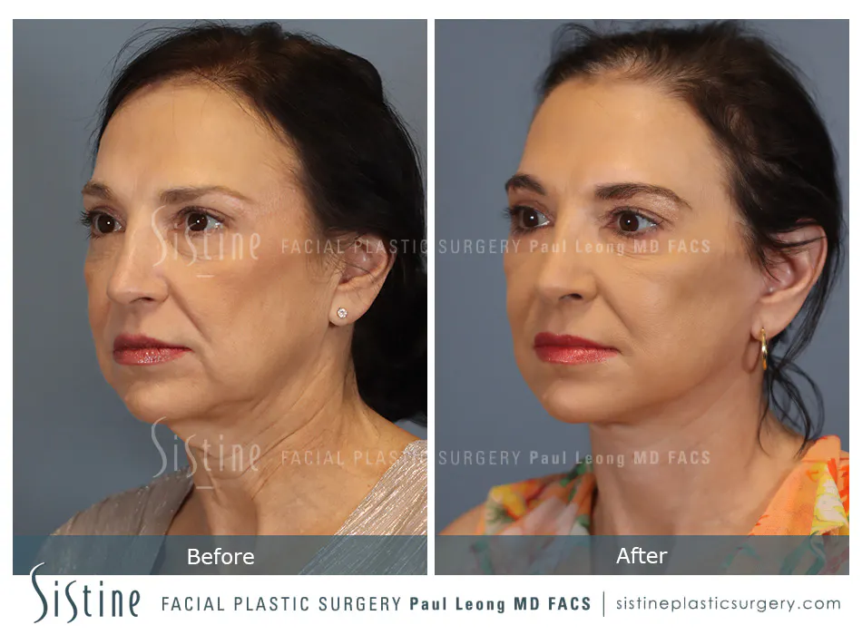 Deep Neck Lift Before and After | Leong Facial Plastic Surgery