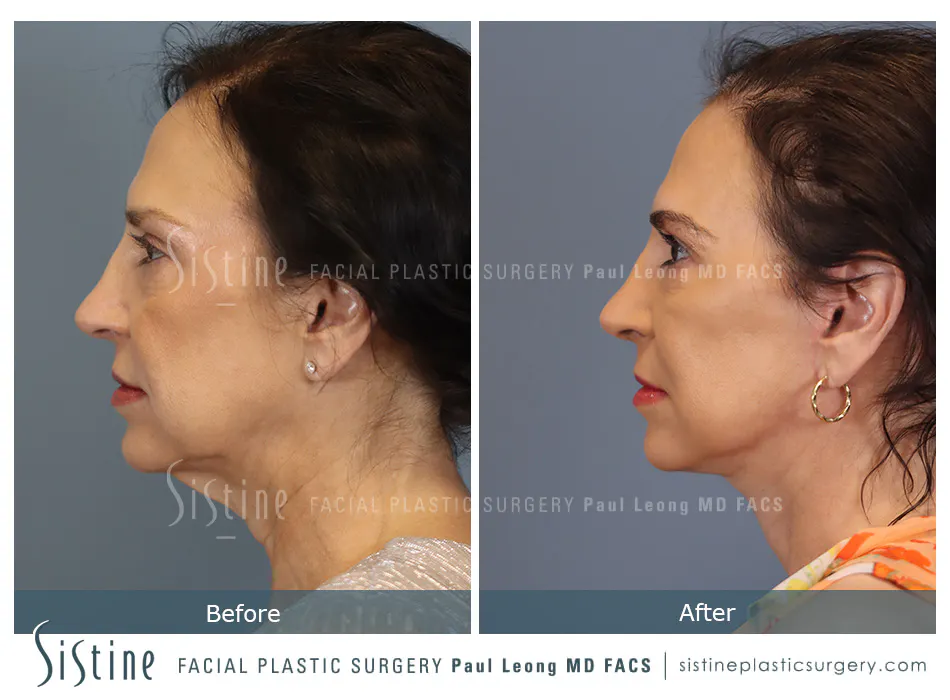 Deep Neck Lift Before and After | Leong Facial Plastic Surgery