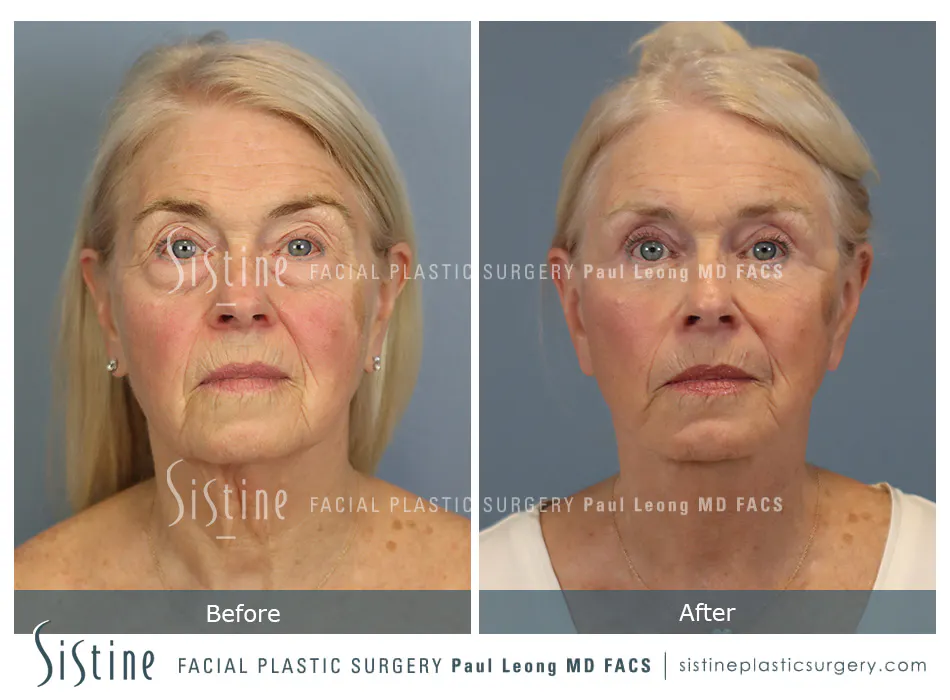 Deep Neck Lift Before and After | Leong Facial Plastic Surgery