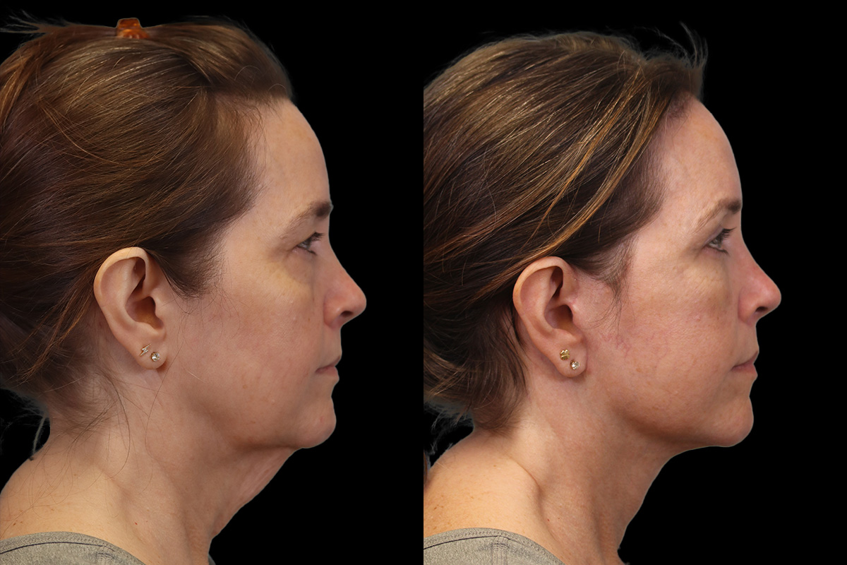  Facelift for Men Pittsburgh - Before Surgery | Sistine Facial Plastic Surgery