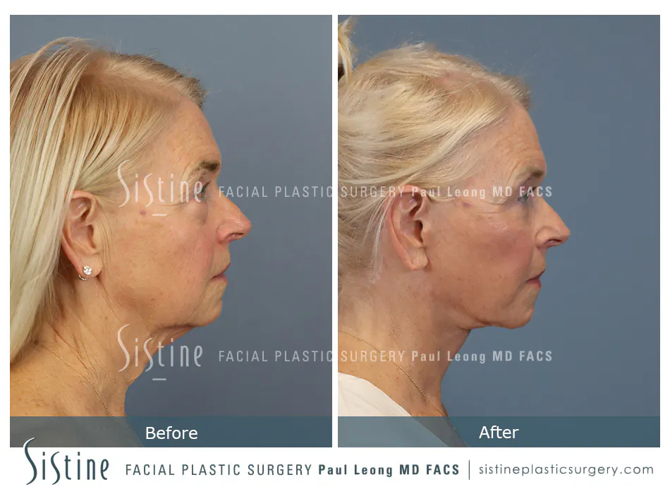 Deep Neck Lift Before and After | Leong Facial Plastic Surgery
