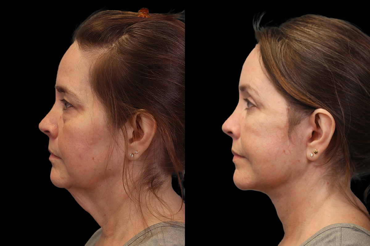  Facelift for Men Pittsburgh - Before Surgery | Sistine Facial Plastic Surgery
