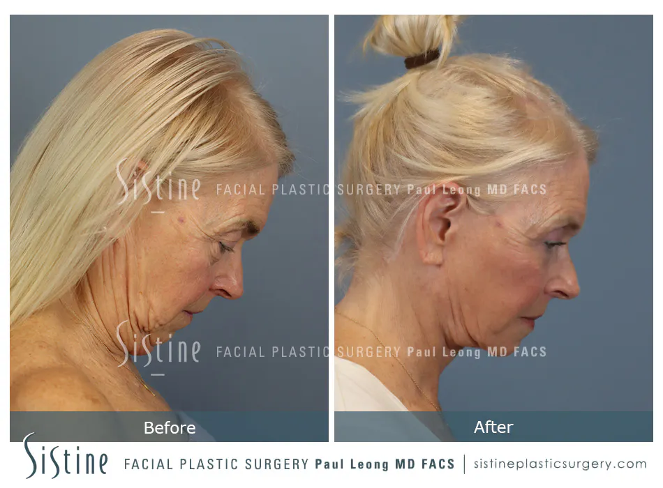 Deep Neck Lift Before and After | Leong Facial Plastic Surgery