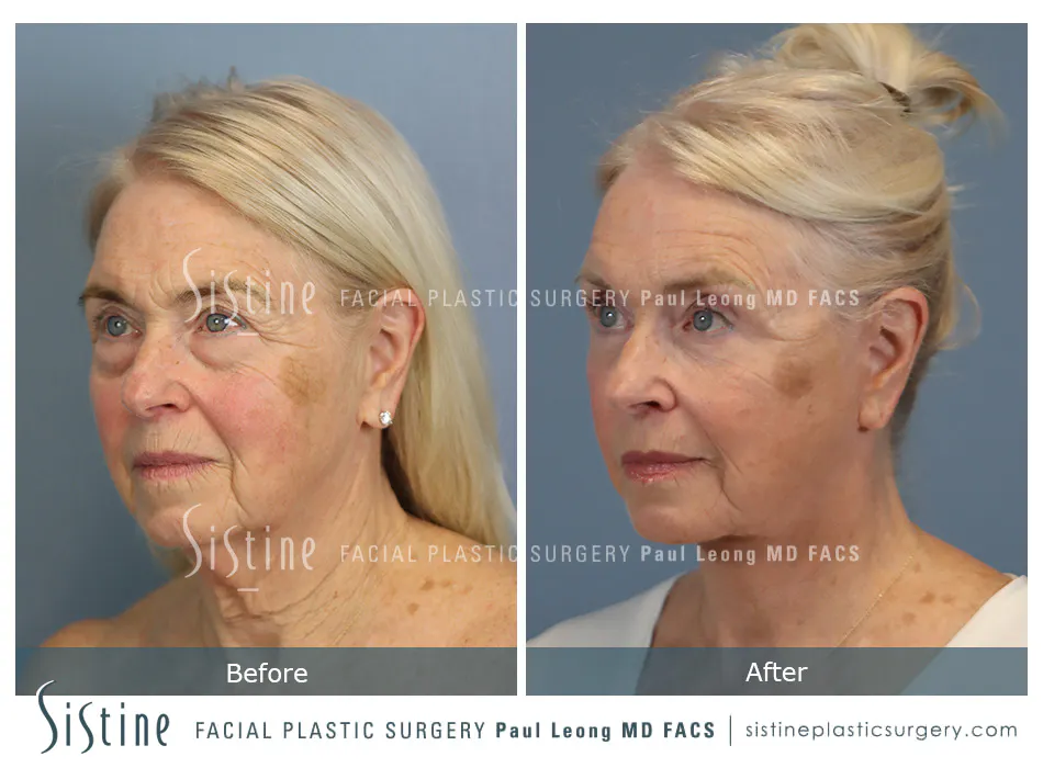 Deep Neck Lift Before and After | Leong Facial Plastic Surgery