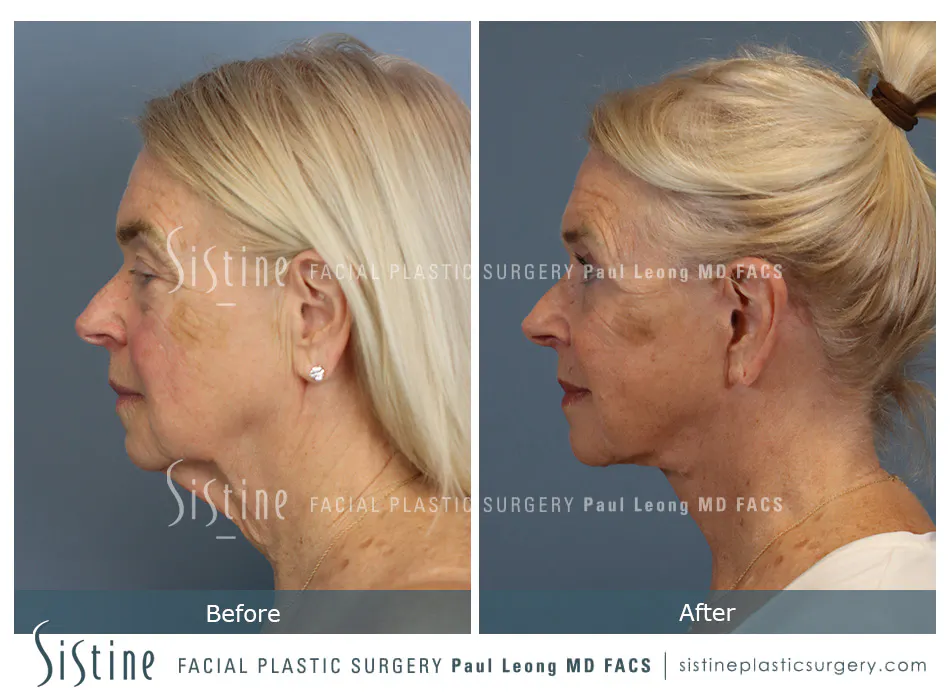 Deep Neck Lift Before and After | Leong Facial Plastic Surgery
