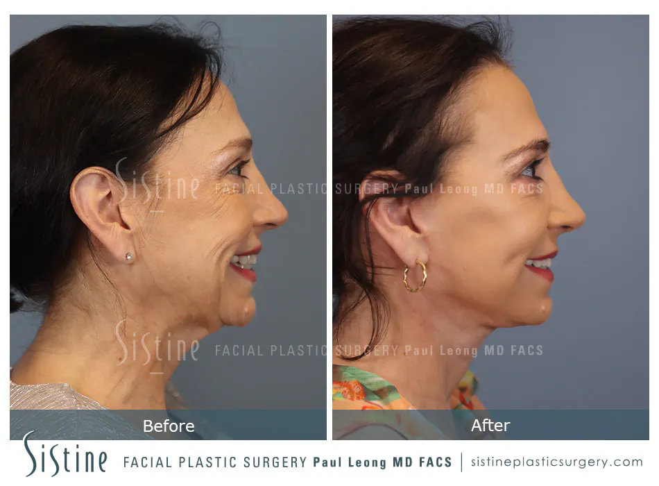Deep Neck Lift Before and After | Leong Facial Plastic Surgery