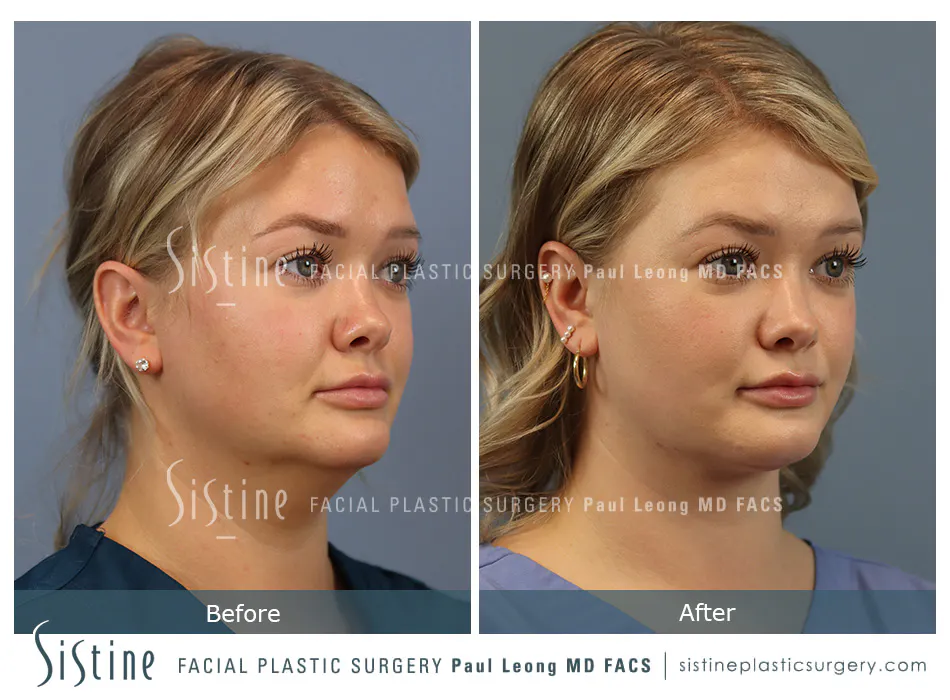 Deep Neck Lift Before and After | Leong Facial Plastic Surgery