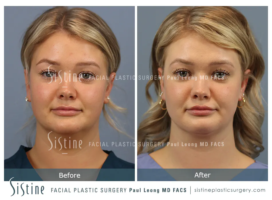 Deep Neck Lift Before and After | Leong Facial Plastic Surgery
