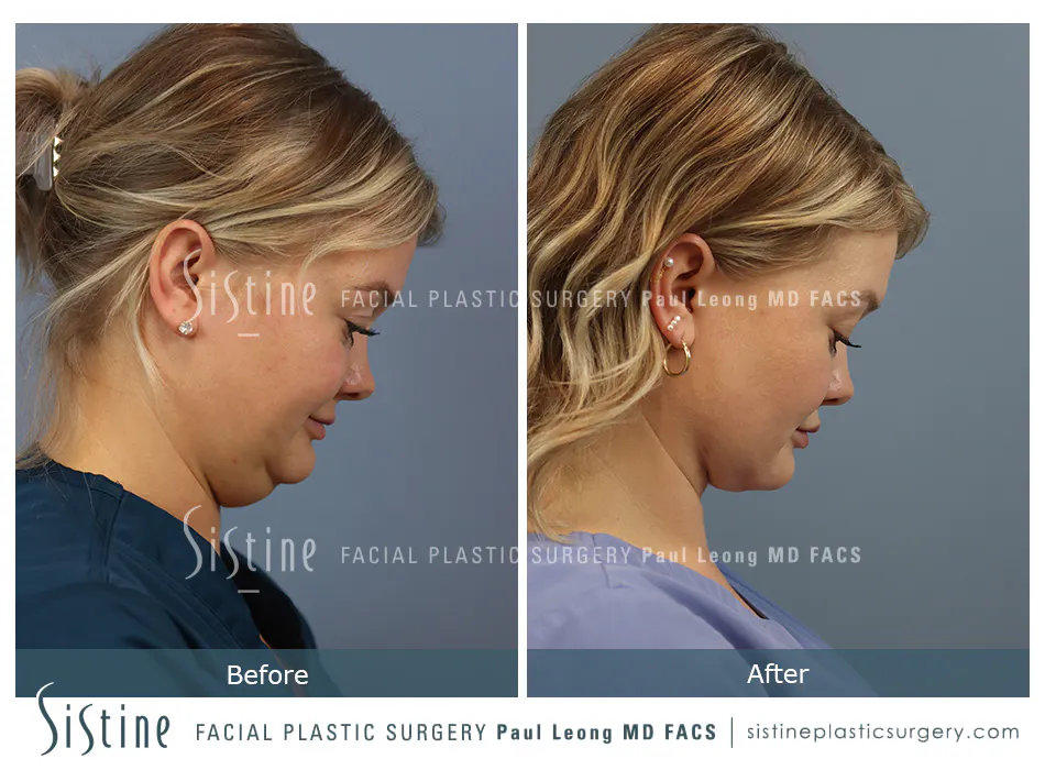 Deep Neck Lift Before and After | Leong Facial Plastic Surgery