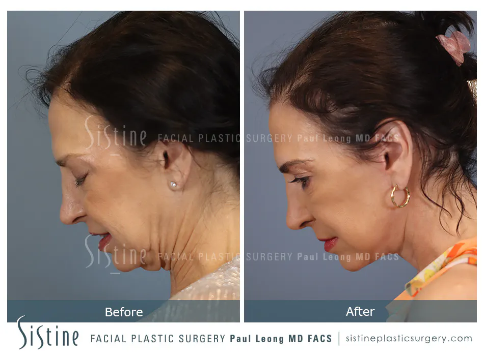 High SMAS Facelift in Pittsburgh - Preoperative Frontal View | Sistine Facial Plastic Surgery