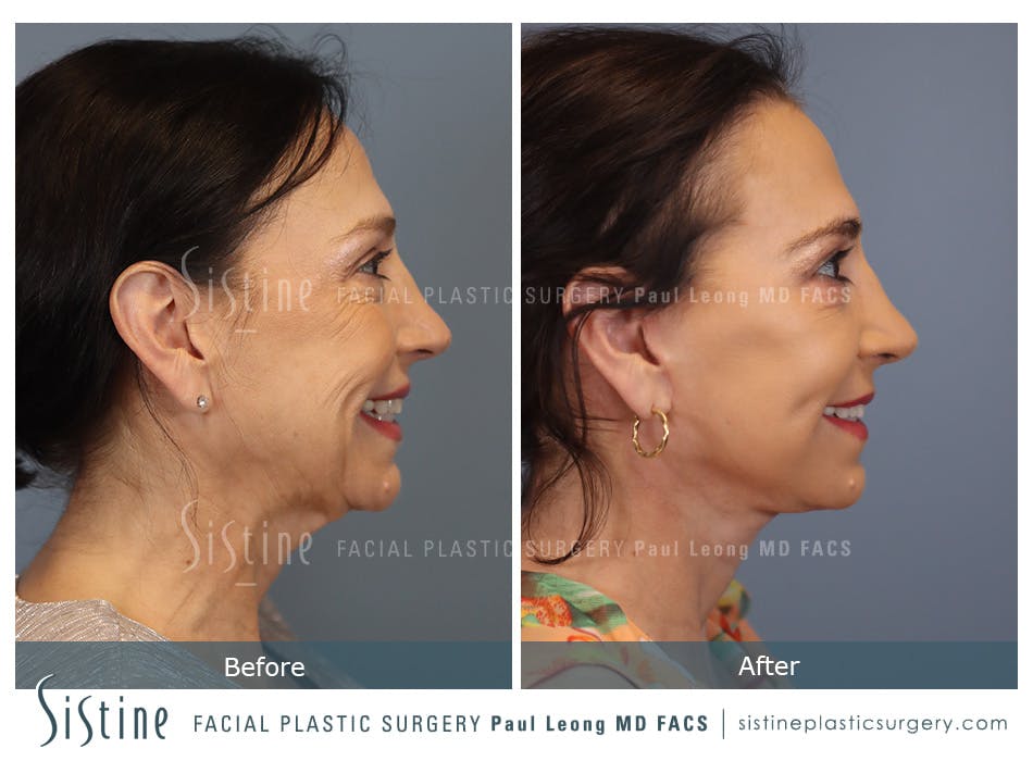 Deep Neck Lift Before and After | Leong Facial Plastic Surgery