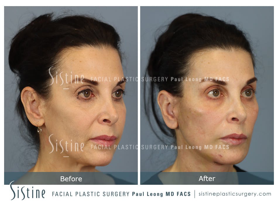 Deep Neck Lift Before and After | Leong Facial Plastic Surgery