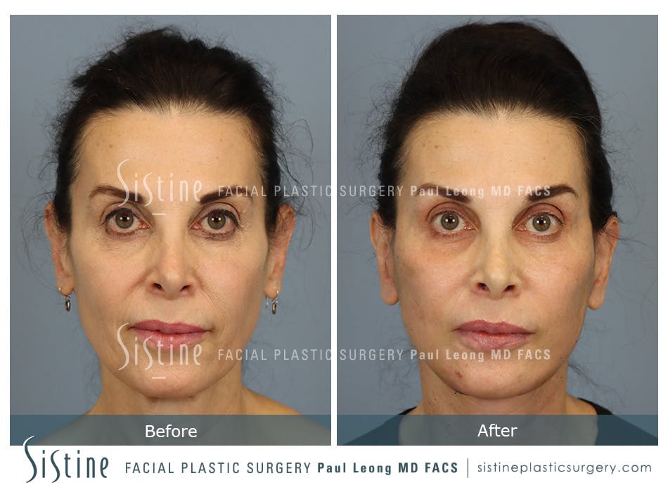 Deep Neck Lift Before and After | Leong Facial Plastic Surgery
