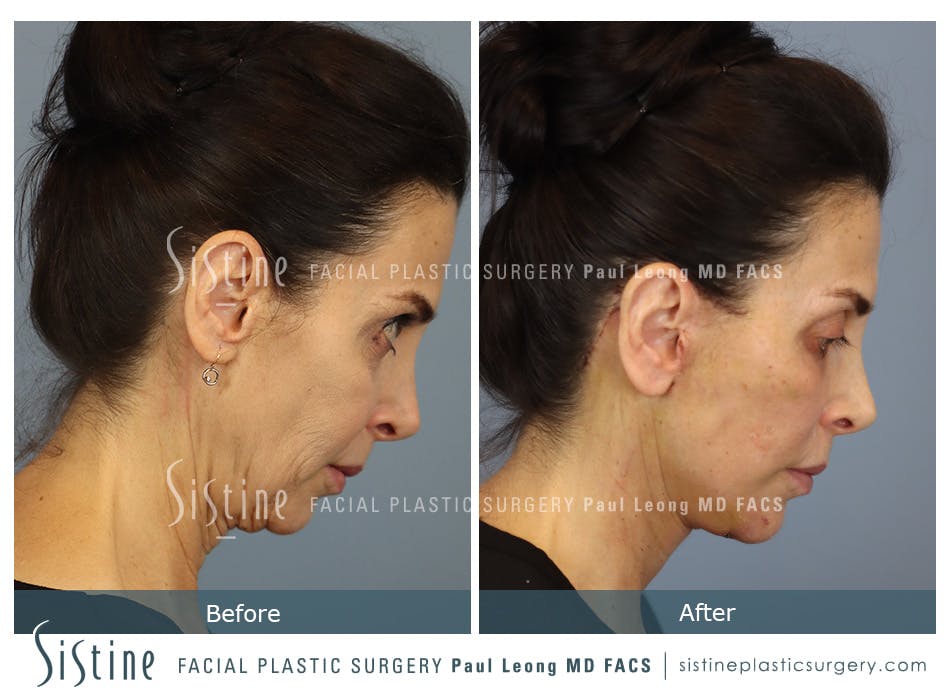 Deep Neck Lift Before and After | Leong Facial Plastic Surgery