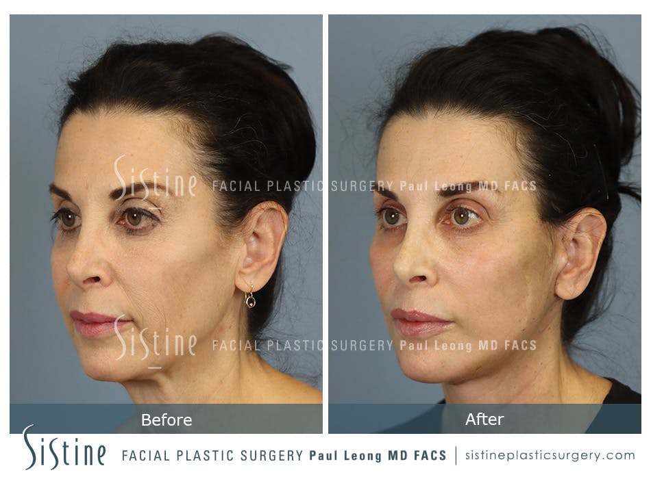Deep Neck Lift Before and After | Leong Facial Plastic Surgery