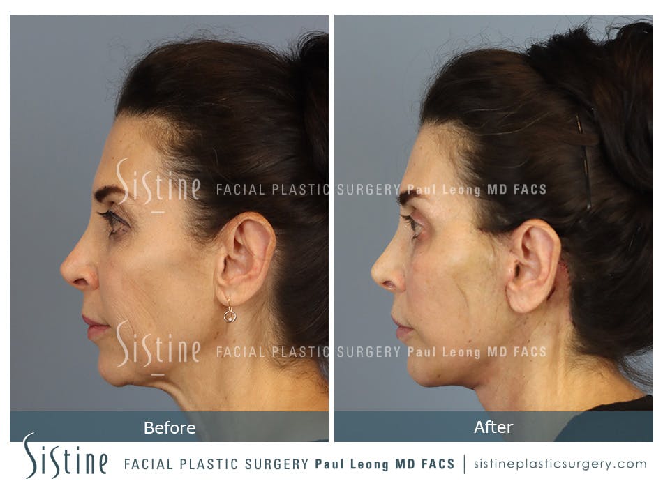 Deep Neck Lift Before and After | Leong Facial Plastic Surgery