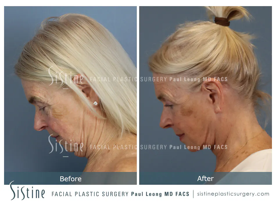Pittsburgh High SMAS Facelift - Preoperative Left Later Chin Tucked View  Sistine Facial Plastic Surgery