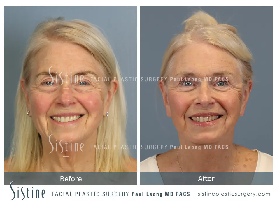 Deep Neck Lift Before and After | Leong Facial Plastic Surgery