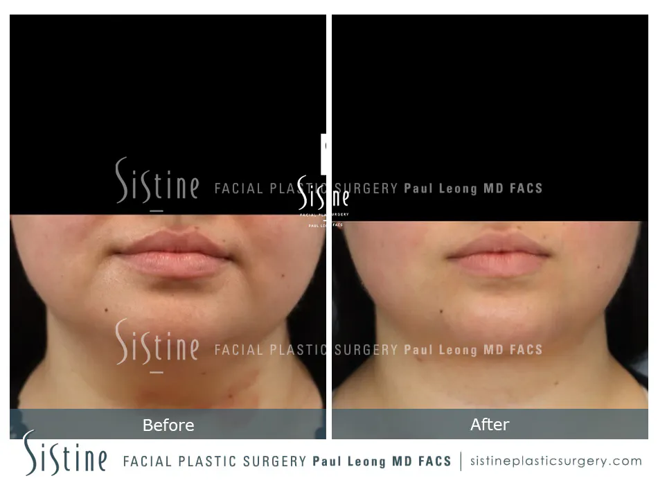 Deep Neck Lift Before and After | Leong Facial Plastic Surgery