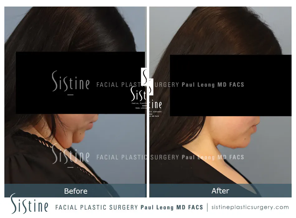 Deep Neck Lift Before and After | Leong Facial Plastic Surgery