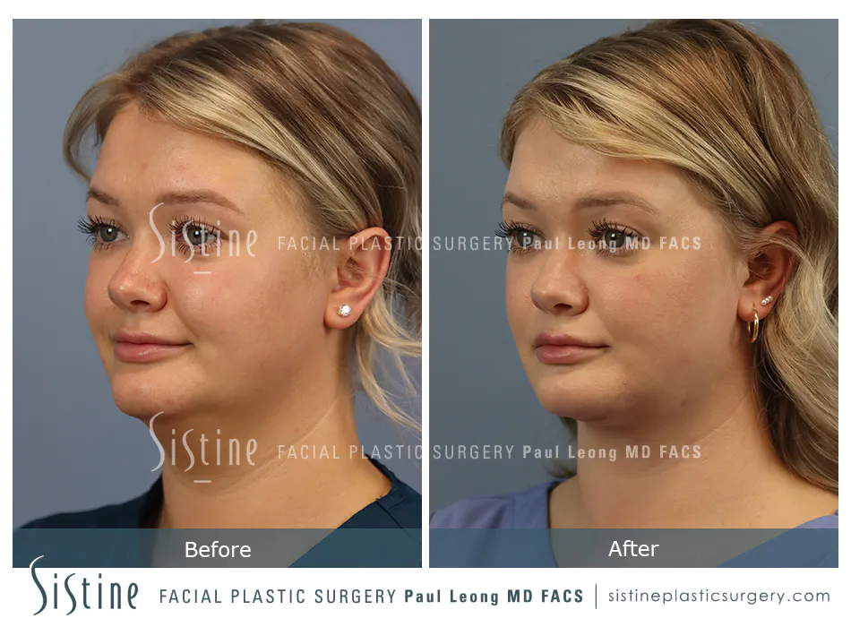 Pittsburgh High SMAS Facelift - Preoperative Left Later Chin Tucked View  Sistine Facial Plastic Surgery
