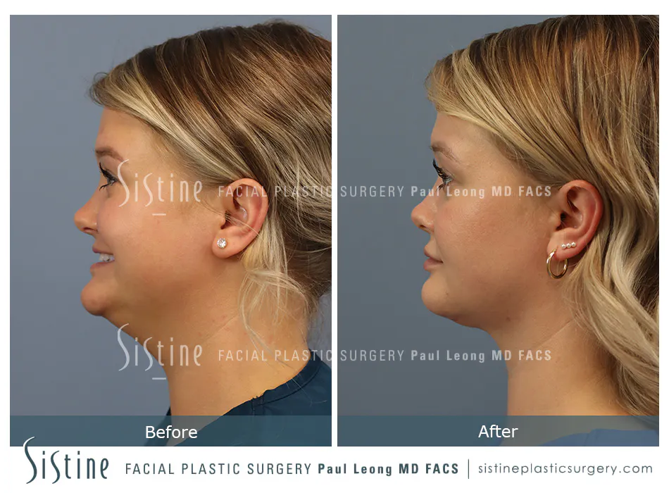 Pittsburgh High SMAS Facelift - Preoperative Left Later Chin Tucked View  Sistine Facial Plastic Surgery