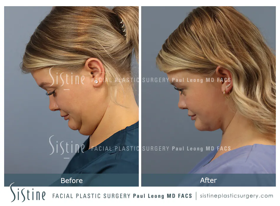 Pittsburgh High SMAS Facelift - Preoperative Left Later Chin Tucked View  Sistine Facial Plastic Surgery