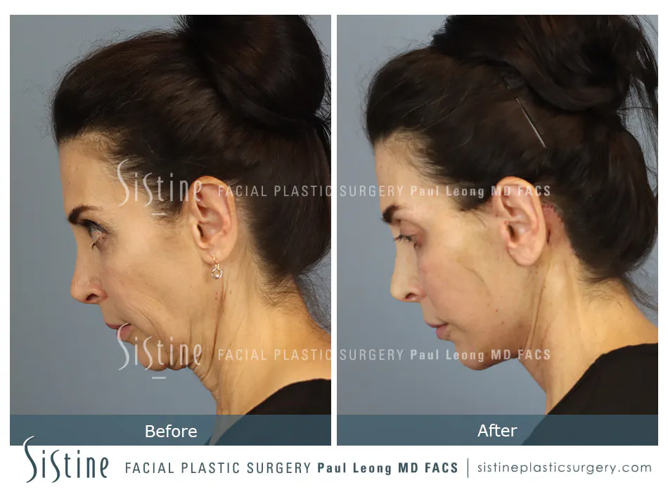 Pittsburgh High SMAS Facelift - Preoperative Left Later Chin Tucked View  Sistine Facial Plastic Surgery