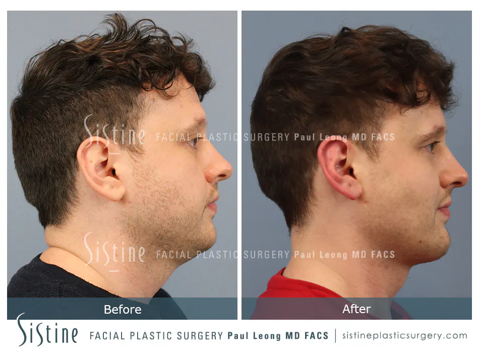 High SMAS Facelift in Pittsburgh - Preoperative Frontal View | Sistine Facial Plastic Surgery