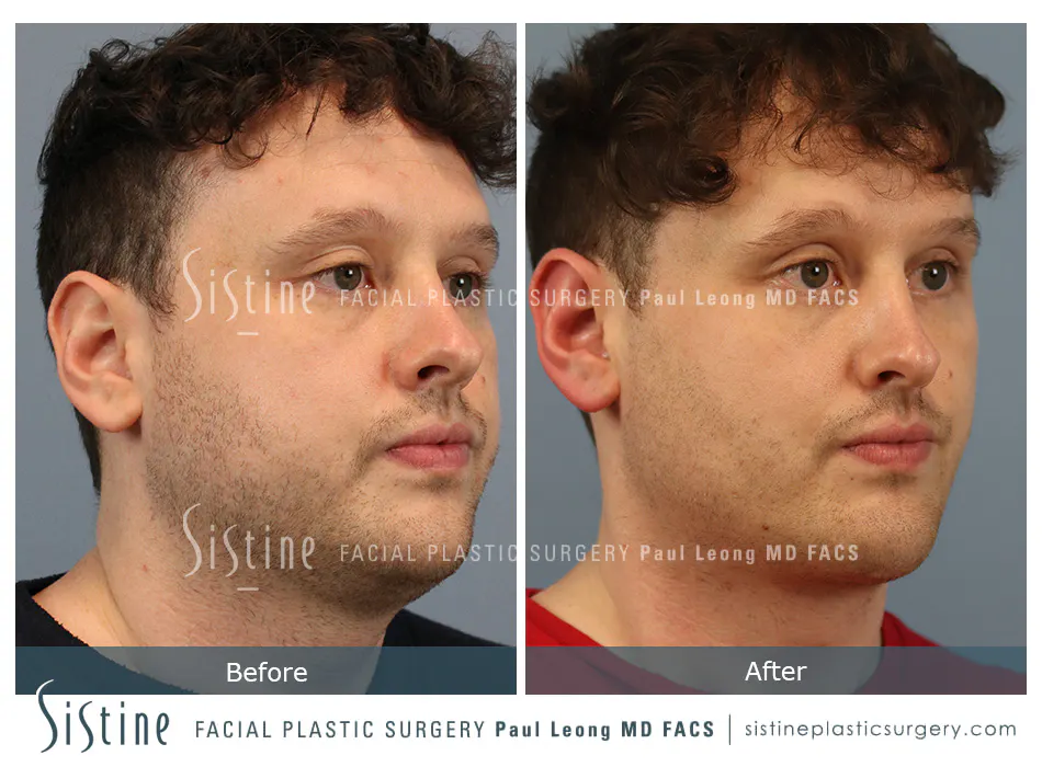 Pittsburgh High SMAS Facelift - Preoperative Left Oblique View | Sistine Facial Plastic Surgery