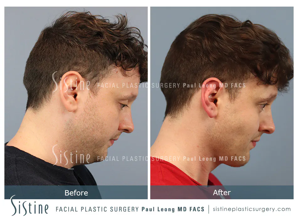 Pittsburgh High SMAS Facelift - Preoperative Right Lateral View | Sistine Facial Plastic Surgery